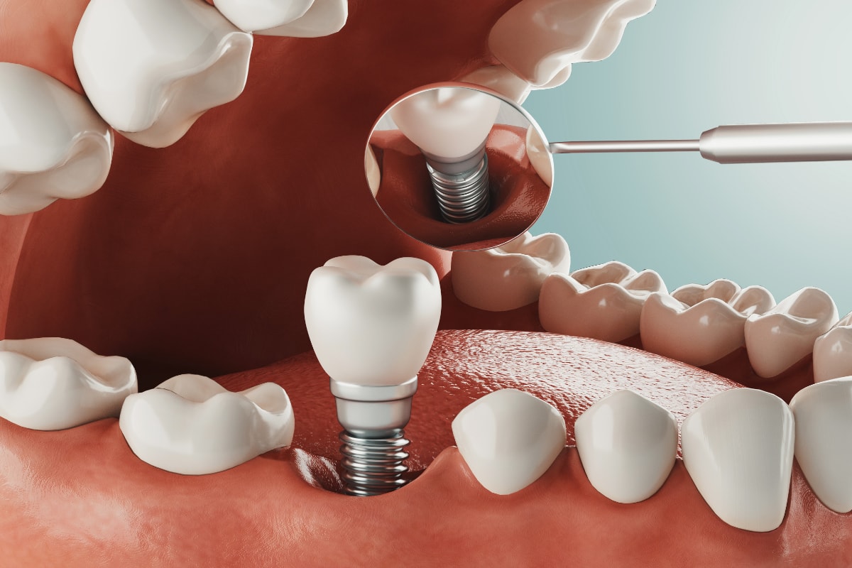 Implantes Dentales Tratamiento Isabel Rosillo
